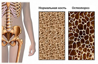 doc_osteoporoz3